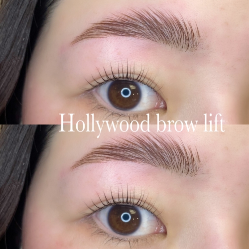 Hollywood brow lift